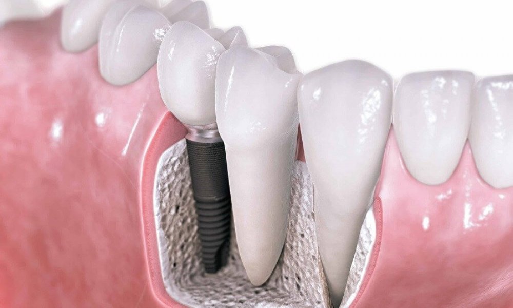 Diş Implantı Nedir? Nasıl Yapılır?