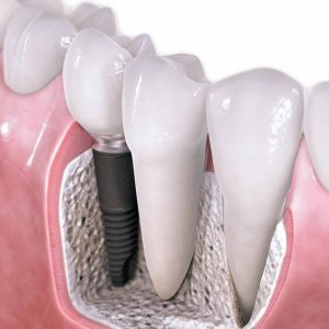 Diş Implantı Nedir? Nasıl Yapılır?
